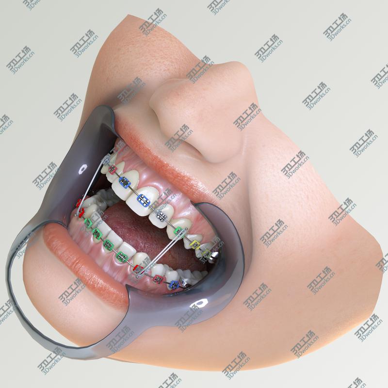 images/goods_img/202104091/Orthodontic Mouth/2.jpg
